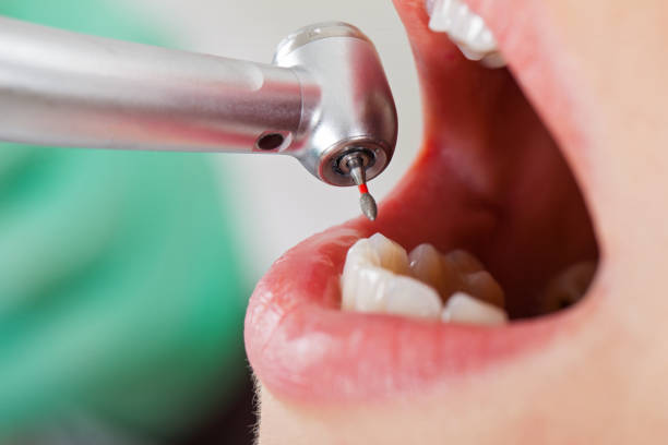 Best Knocked-Out Tooth (Avulsed Tooth) Treatment in Sibley, LA